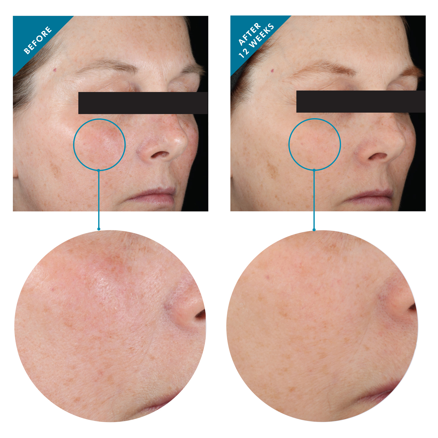 Skinceuticals Metacell Renewal B3 before after