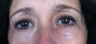 bobbi right eye