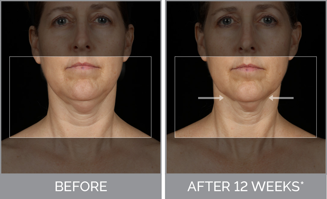 clarisonic smart profile uplift before after results